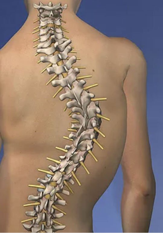 Scoliosis Diagram