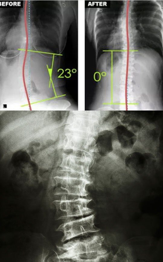 Scoliosis Intensive Care