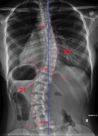 Scoliosis Spine Xray after Braces