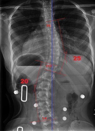 Scoliosis Spine Xray with Braces